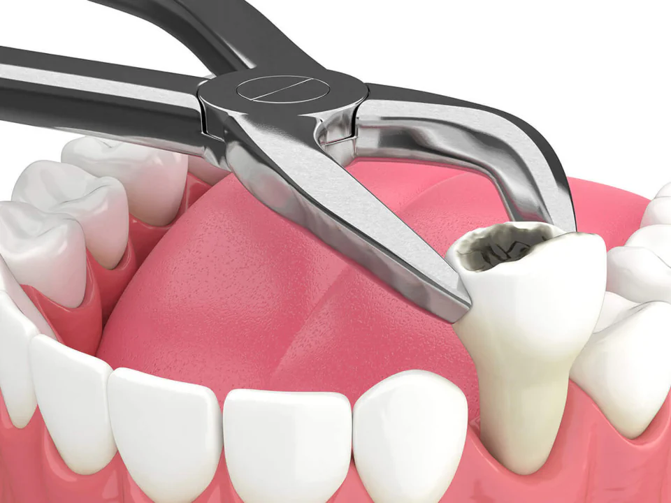 Tooth extractions in West Allis, WI at Third Coast Family Dental.