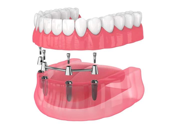 All-on-4 dental implants in West Allis, WI at Third Coast Family Dental.