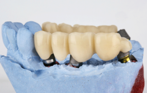 Dental bridge model