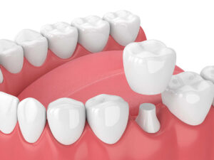 3D illustration of a dental crown being placed