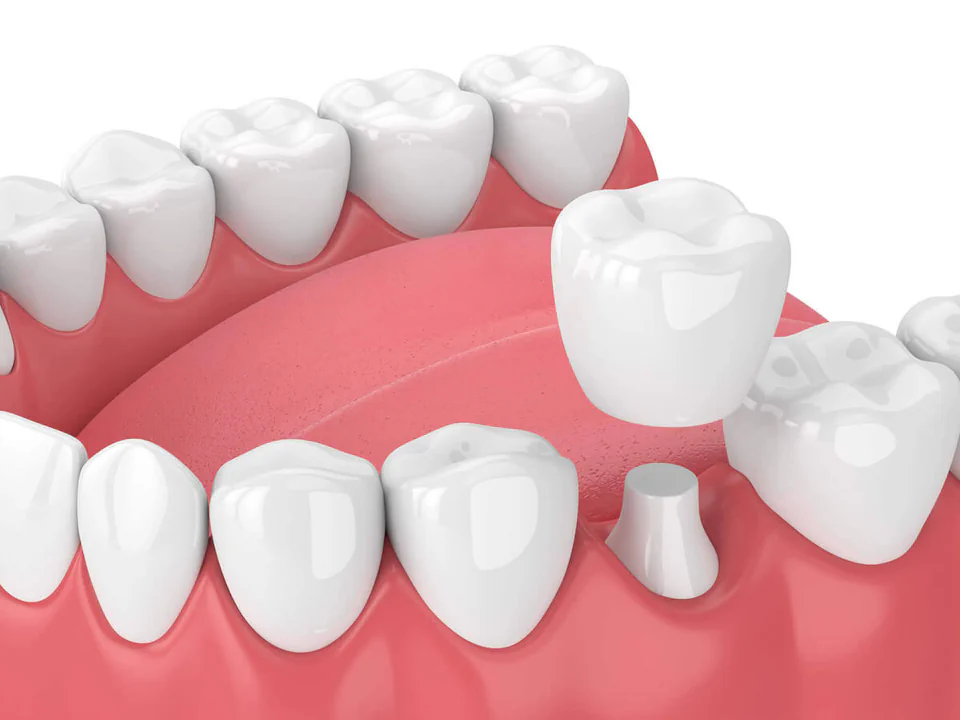Dental crowns in West Allis, WI at Third Coast Family Dental.