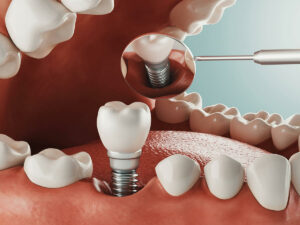 3D illustration of a dental implant