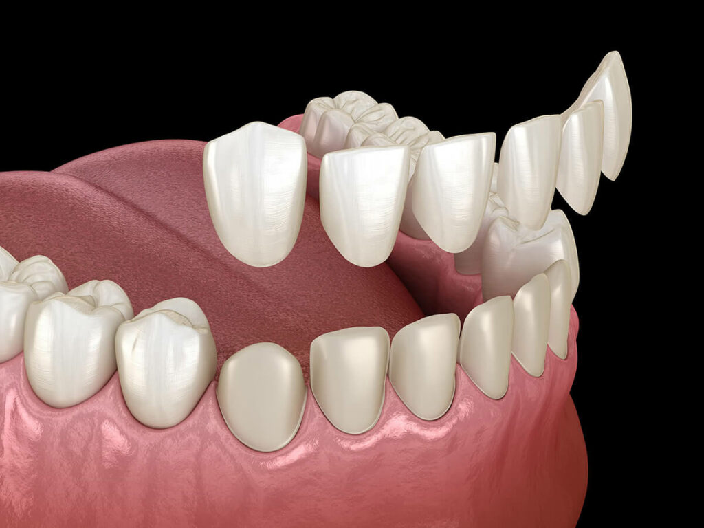 3D illustration of dental veneers being placed on teeth