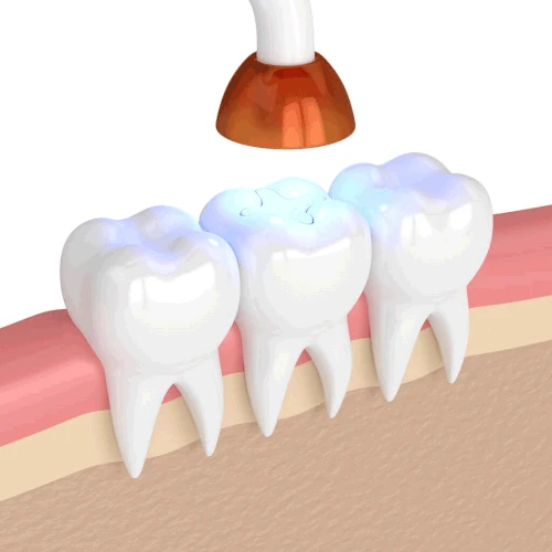 Tooth fillings and dental sealants in West Allis, WI at Third Coast Family Dental.