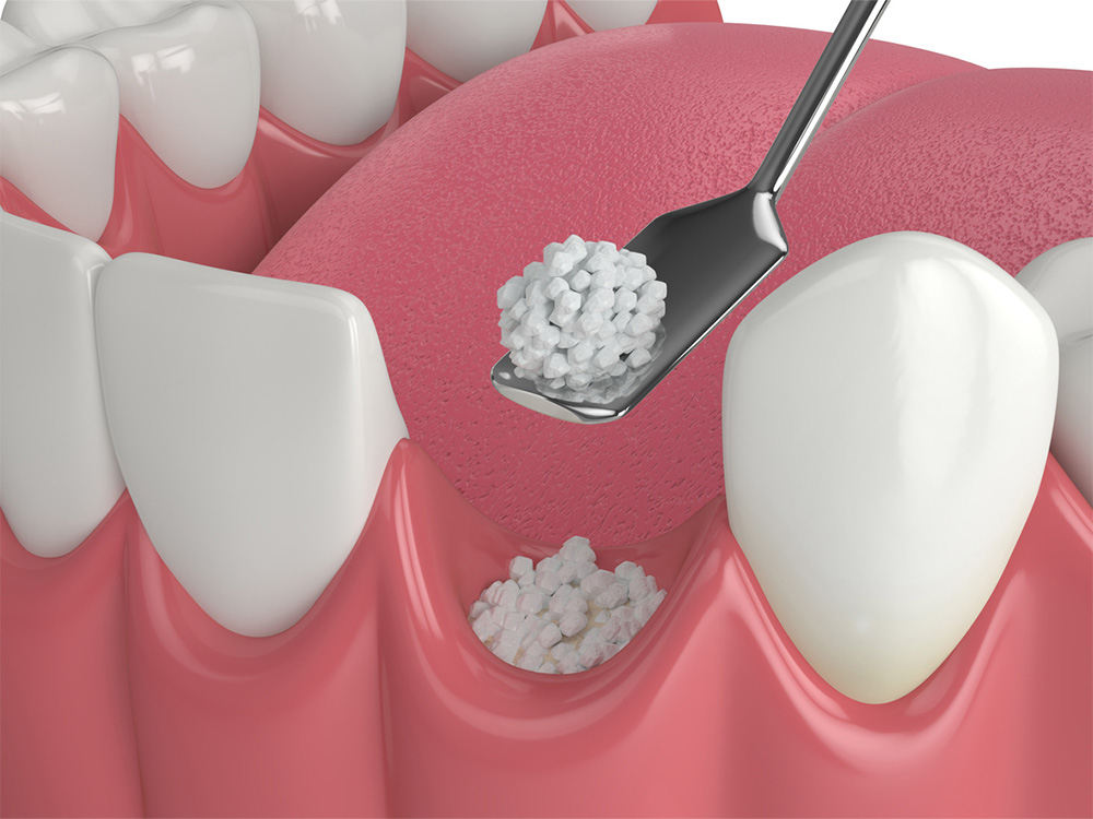 The image is a detailed digital illustration showing a dental procedure where a dental instrument is placing bone graft material into the gum tissue, likely for the purpose of preparing the site for a dental implant or for periodontal regeneration.