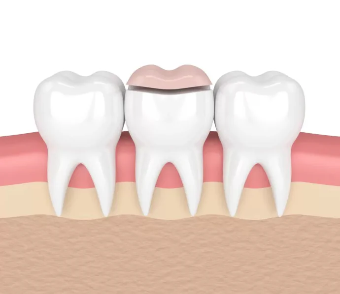 Dental inlays and dental onlays in West Allis, WI at Third Coast Family Dental.
