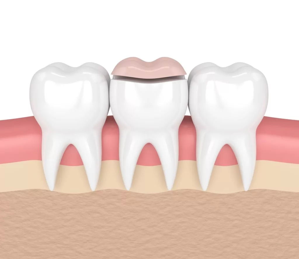 The image is a digital illustration showing a dental procedure where a tooth is being prepared for a crown. The middle tooth has a reduced surface, with a dental crown positioned above it, ready to be placed. The illustration includes adjacent teeth, gum tissue, and a cross-section of the jawbone.