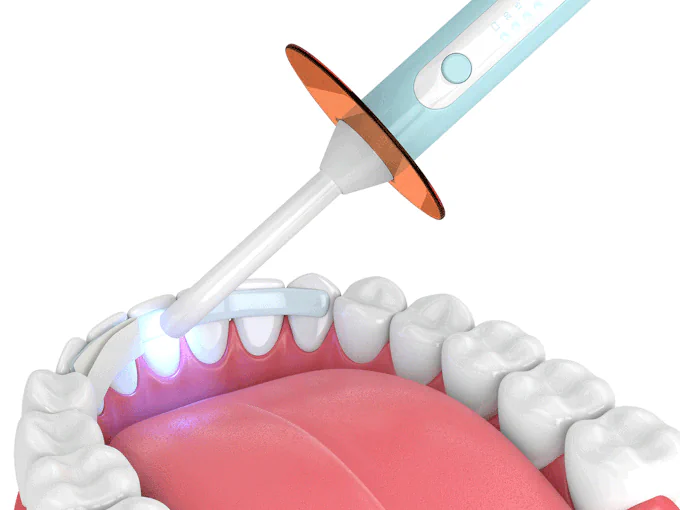 Dental bonding in West Allis, WI at Third Coast Family Dental.