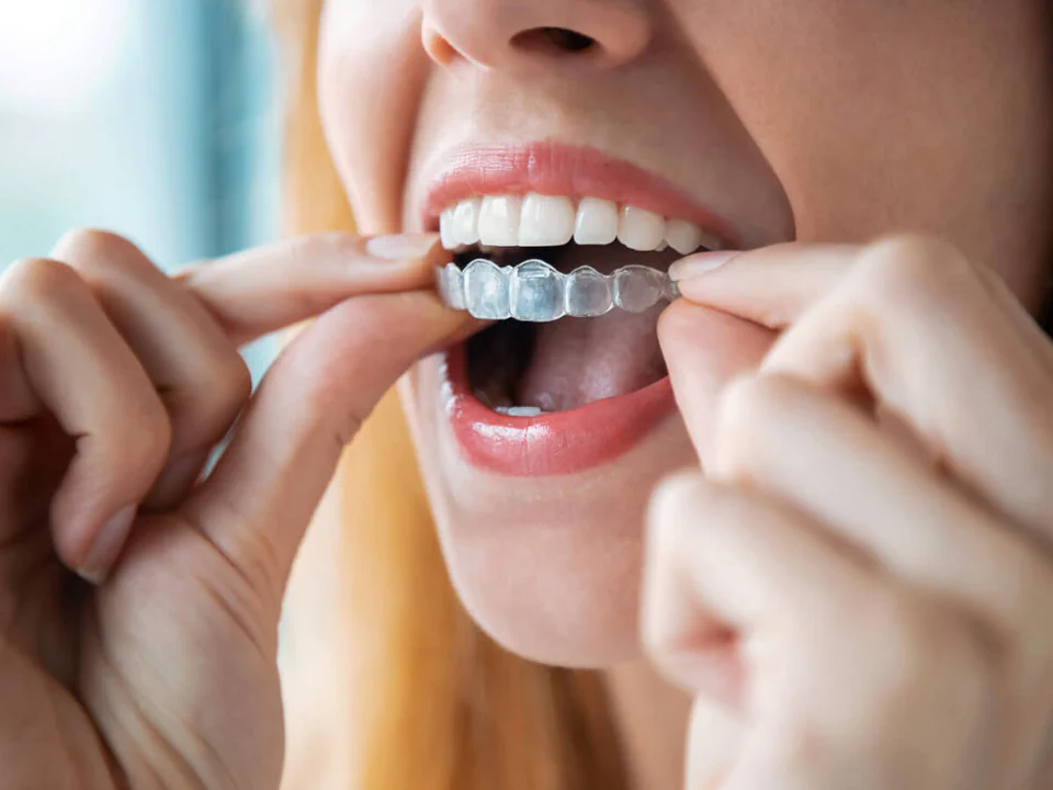 Invisalign clear aligners in West Allis, WI at Third Coast Family Dental.