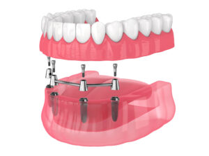 The image shows a detailed 3D illustration of a dental implant procedure, depicting the installation of a full arch prosthesis supported by multiple implants anchored in the lower jaw.