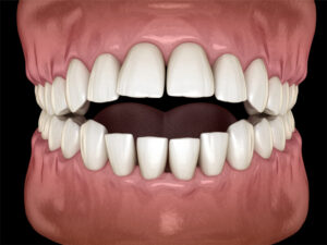 The image shows a realistic 3D illustration of a mouth with an overbite, where the upper front teeth significantly overlap the lower front teeth.