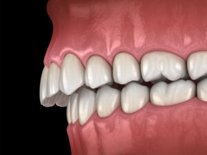 The image shows a realistic 3D illustration of a severe overbite, viewed from a close-up side angle, where the upper front teeth significantly overlap the lower front teeth.