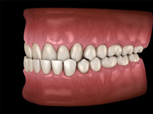 The image shows a realistic 3D illustration of a side view of a mouth with an overbite, where the upper front teeth significantly overlap the lower front teeth.