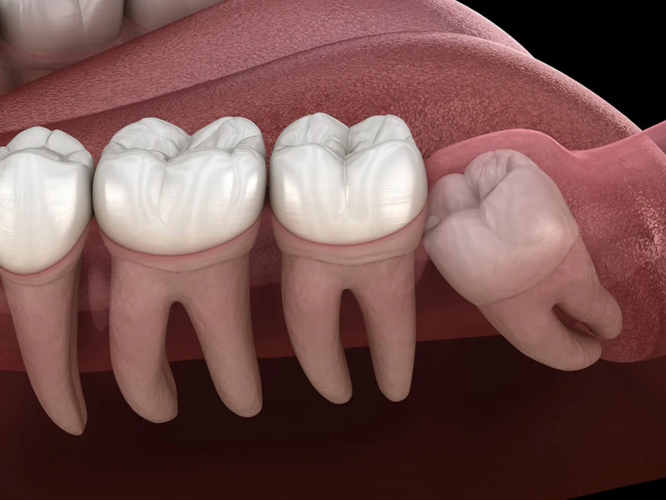 Wisdom tooth removal in West Allis, WI at Third Coast Family Dental.